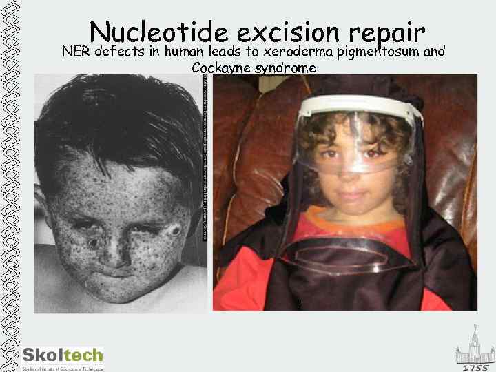 Nucleotide excision repair NER defects in human leads to xeroderma pigmentosum and Cockayne syndrome