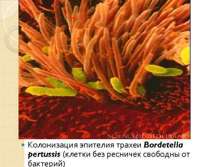  Колонизация эпителия трахеи Bordetella pertussis (клетки без ресничек свободны от бактерий) 
