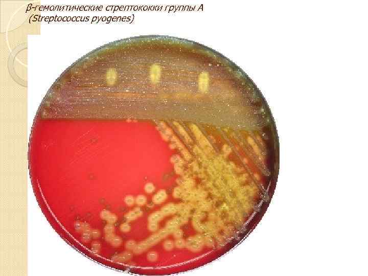 β-гемолитические стрептококки группы А (Streptococcus pyogenes) 