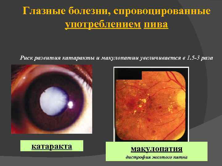 Глазные болезни, спровоцированные употреблением пива Риск развития катаракты и макулопатии увеличивается в 1. 5