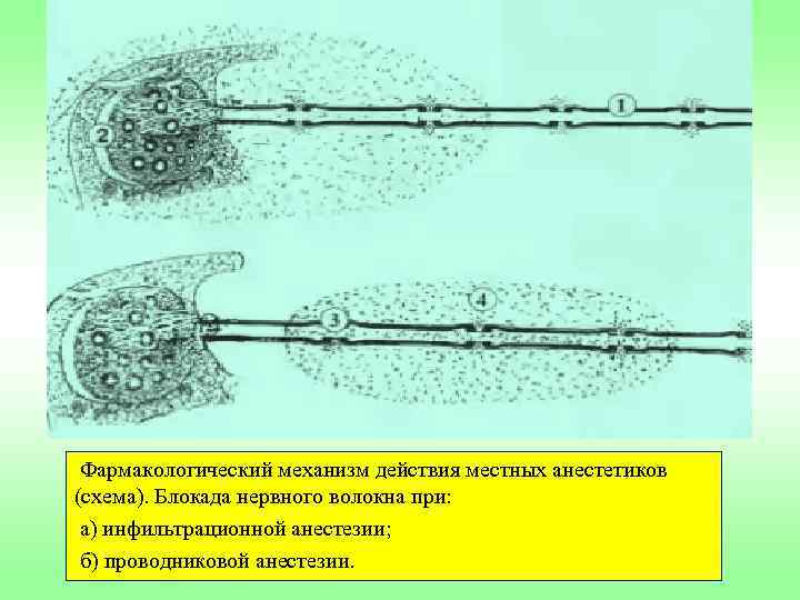 Фармакологический механизм действия местных анестетиков (схема). Блокада нервного волокна при: а) инфильтрационной анестезии; б)