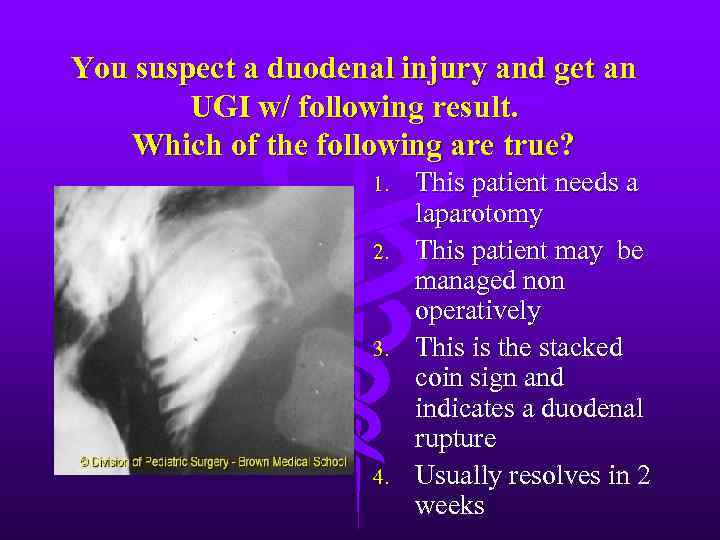 You suspect a duodenal injury and get an UGI w/ following result. Which of