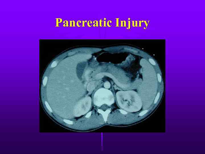 Pancreatic Injury 