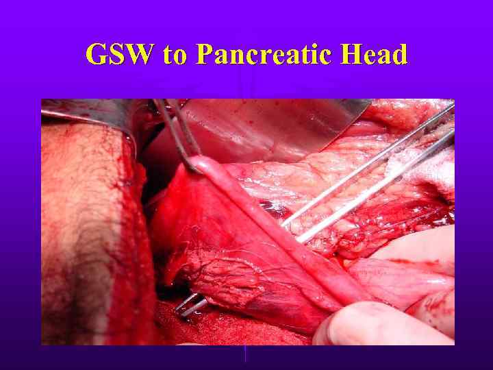 GSW to Pancreatic Head 