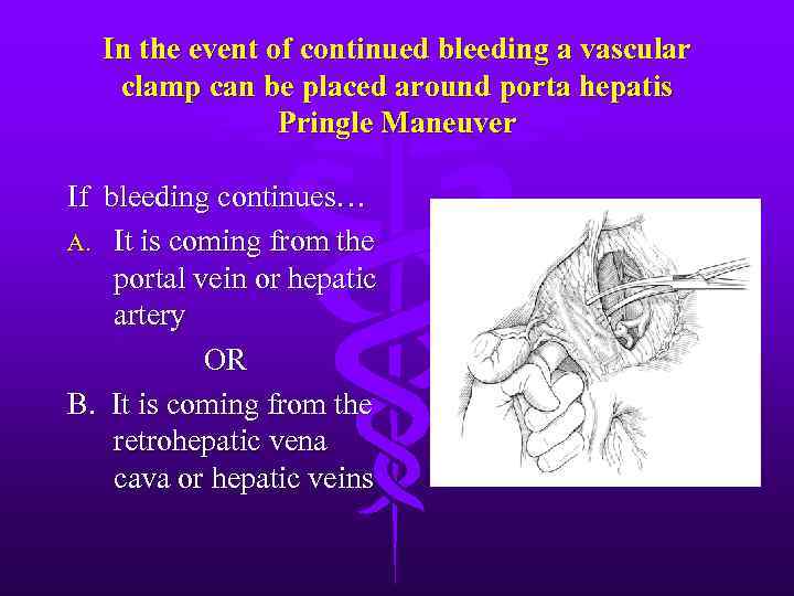 In the event of continued bleeding a vascular clamp can be placed around porta