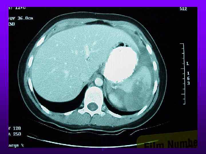 Splenic Injury 