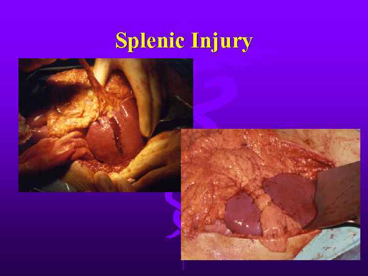 Splenic Injury 