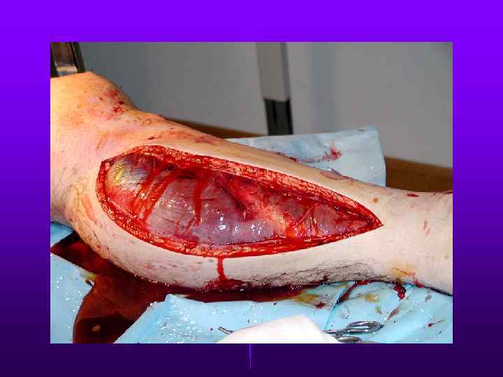 Fasciotomy 