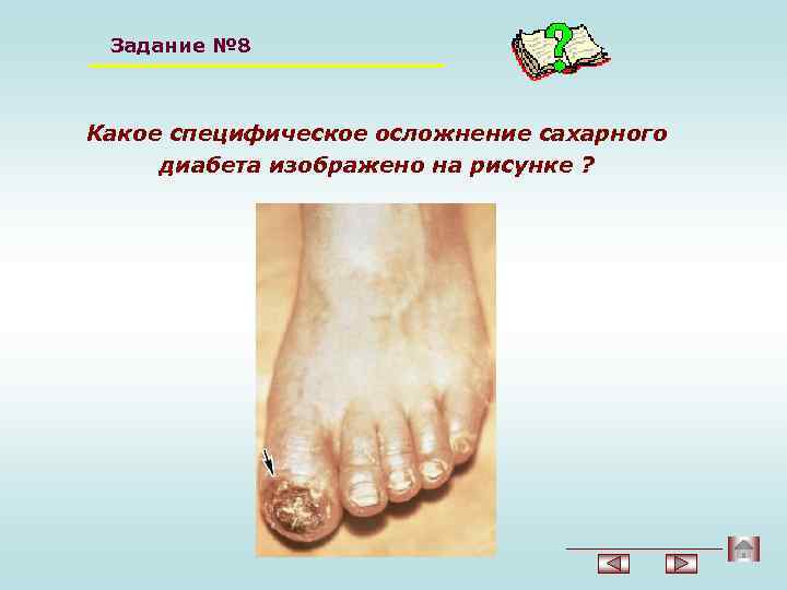 Задание № 8 Какое специфическое осложнение сахарного диабета изображено на рисунке ? 