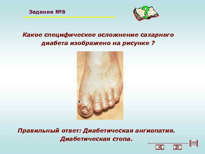Задание № 8 Какое специфическое осложнение сахарного диабета изображено на рисунке ? Правильный ответ: