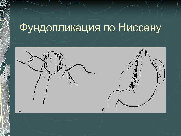 Фундопликация по Ниссену 