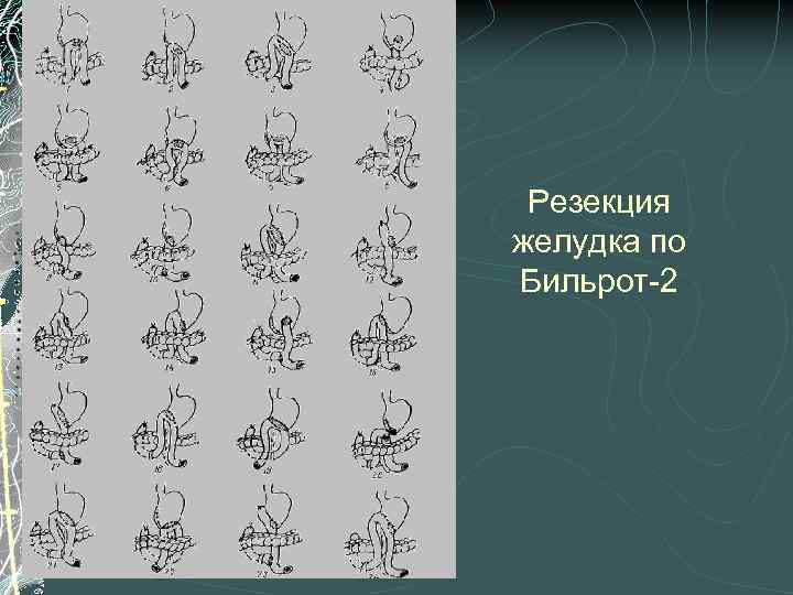 Резекция желудка по Бильрот-2 