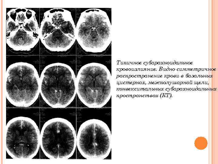 Типичное субарахноидальное кровоизлияние. Видно симметричное распространение крови в базальных цистернах, межполушарной щели, конвекситальных субарахноидальных