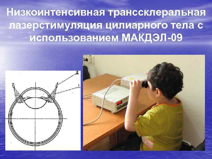 Низкоинтенсивная транссклеральная лазерстимуляция цилиарного тела с использованием МАКДЭЛ-09 