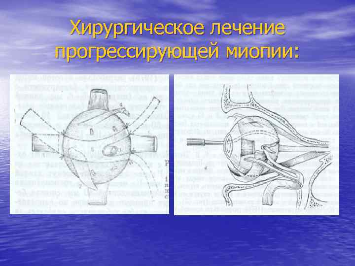 Хирургическое лечение прогрессирующей миопии: 