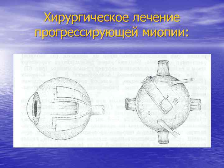 Хирургическое лечение прогрессирующей миопии: 