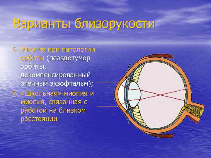 Варианты близорукости 6. Миопия при патологии орбиты (псевдотумор орбиты, декомпенсированный отечный экзофтальм); 7. «Школьная»