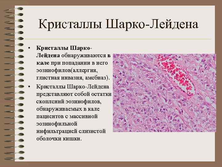 Кристаллы Шарко-Лейдена • Кристаллы Шарко. Лейдена обнаруживаются в кале при попадании в него эозинофилов(аллергия,