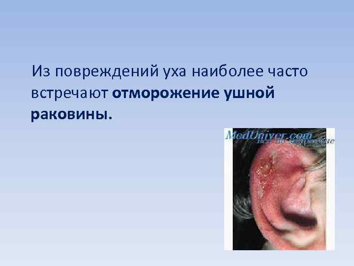  Из повреждений уха наиболее часто встречают отморожение ушной раковины. 