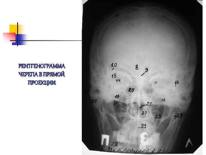 Прямая проекция рентгенограмма