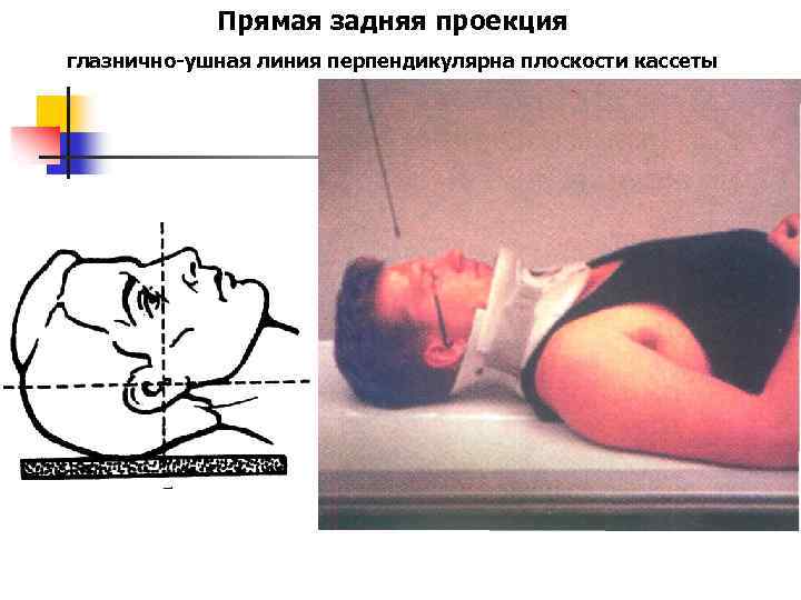 Прямая задняя проекция глазнично-ушная линия перпендикулярна плоскости кассеты 