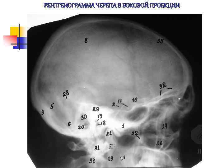 РЕНТГЕНОГРАММА ЧЕРЕПА В БОКОВОЙ ПРОЕКЦИИ 