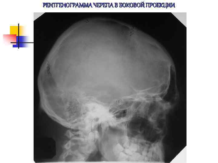РЕНТГЕНОГРАММА ЧЕРЕПА В БОКОВОЙ ПРОЕКЦИИ 