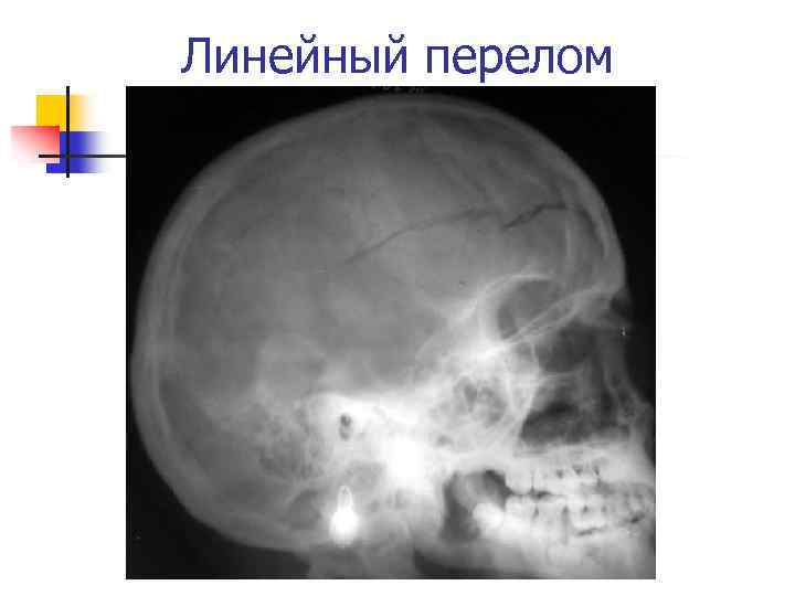 Линейная трещина. Линейный перелом лобной кости. Линейный перелом свода черепа. Линейный перелом затылочной кости у ребенка. Линейный перелом черепа у ребенка.