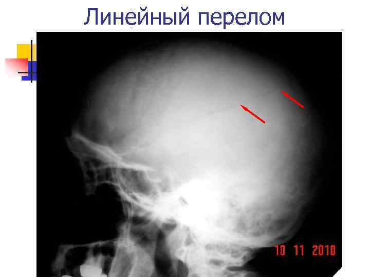 Линейная трещина. Линейный перелом височной кости на кт.