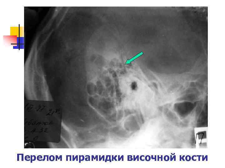 Перелом пирамидки височной кости 