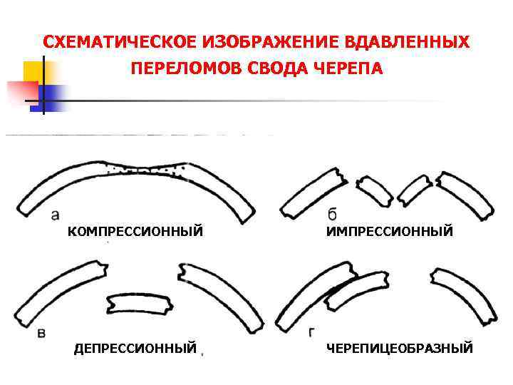 Импрессионный перелом. Импрессионный вдавленный перелом свода черепа. Компрессионный перелом черепа. Компрессионный перелом костей свода черепа. Импрессионные вдавленные переломы черепа.