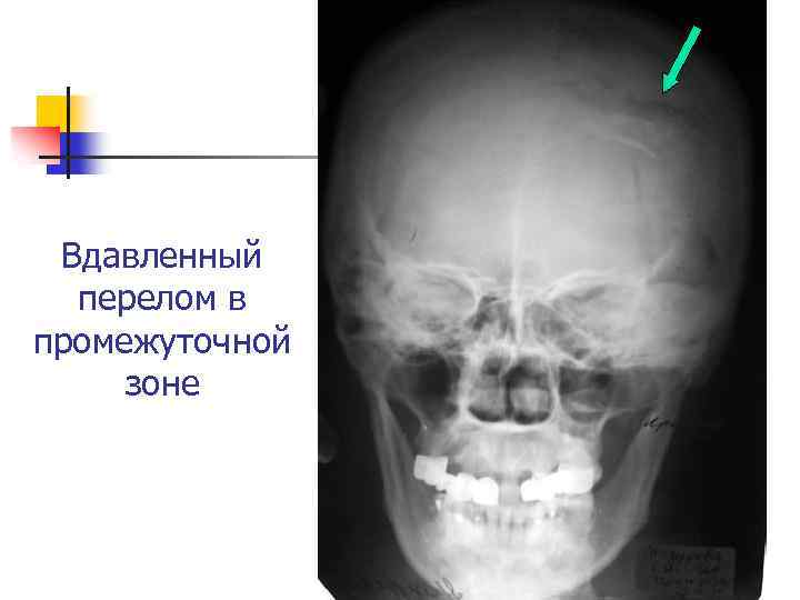 Вдавленный перелом в промежуточной зоне 