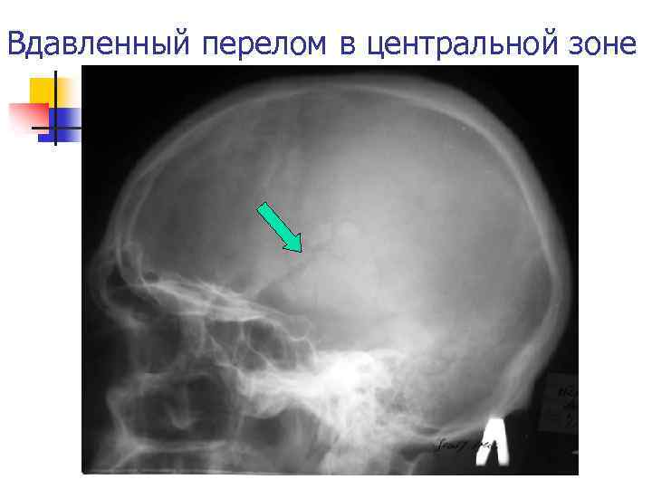 Вдавленный перелом в центральной зоне 