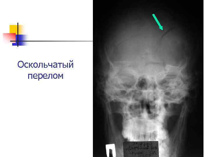 Оскольчатый перелом 