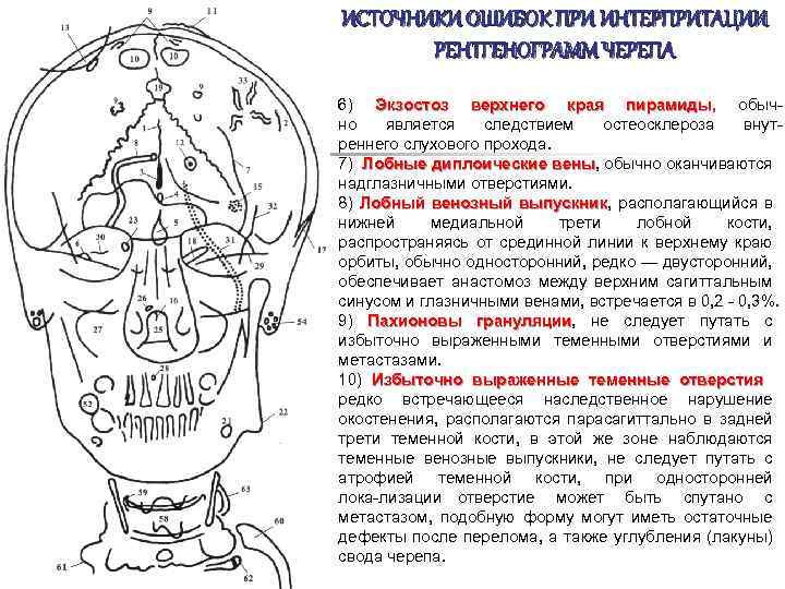 ИСТОЧНИКИ ОШИБОК ПРИ ИНТЕРПРИТАЦИИ РЕНТГЕНОГРАММ ЧЕРЕПА 6) Экзостоз верхнего края пирамиды, обыч но является