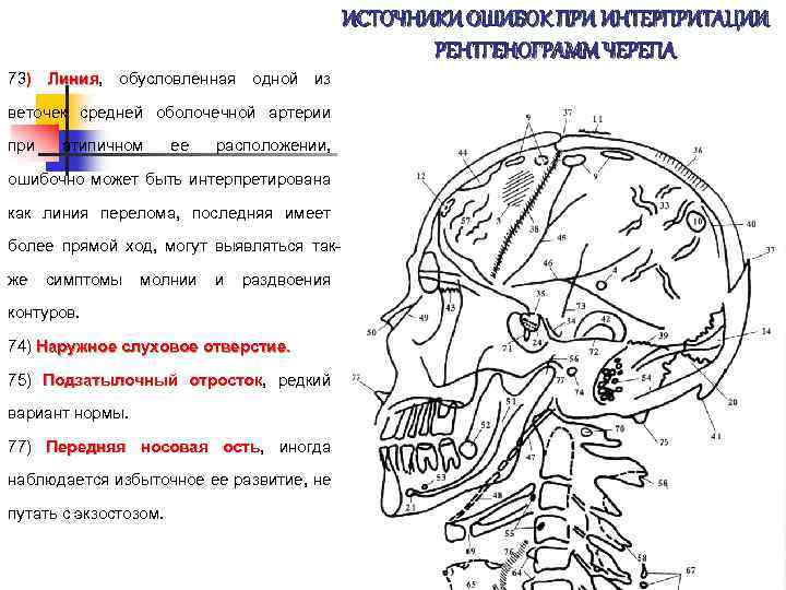 ИСТОЧНИКИ ОШИБОК ПРИ ИНТЕРПРИТАЦИИ РЕНТГЕНОГРАММ ЧЕРЕПА 73) Линия, обусловленная одной из Линия веточек средней