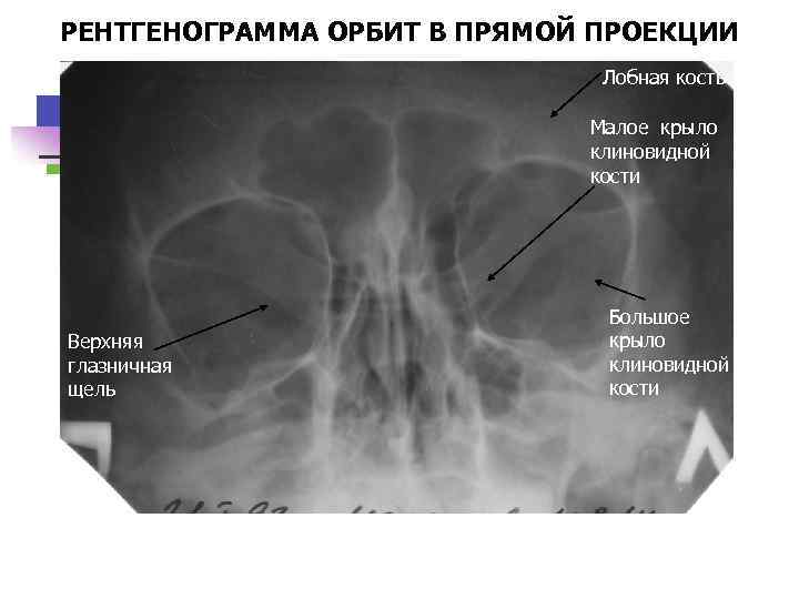 РЕНТГЕНОГРАММА ОРБИТ В ПРЯМОЙ ПРОЕКЦИИ Лобная кость Малое крыло клиновидной кости Верхняя глазничная щель