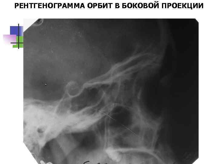 РЕНТГЕНОГРАММА ОРБИТ В БОКОВОЙ ПРОЕКЦИИ 