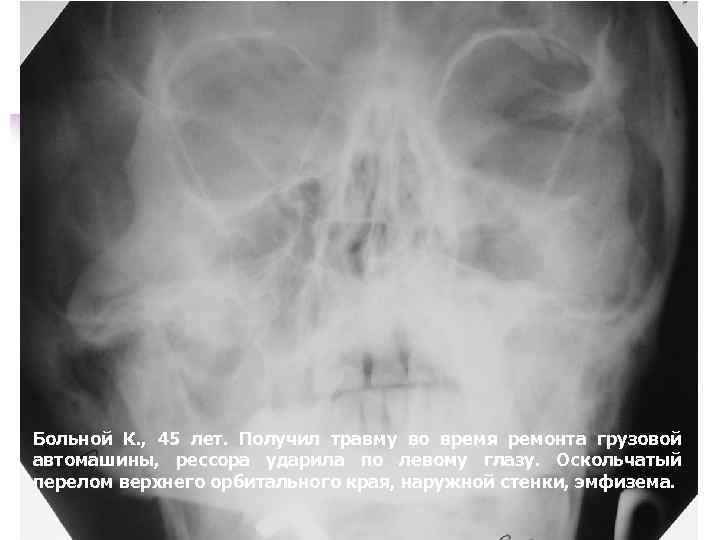 Больной К. , 45 лет. Получил травму во время ремонта грузовой автомашины, рессора ударила