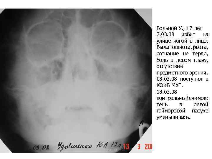 Больной У. , 17 лет 7. 03. 08 избит на улице ногой в лицо.
