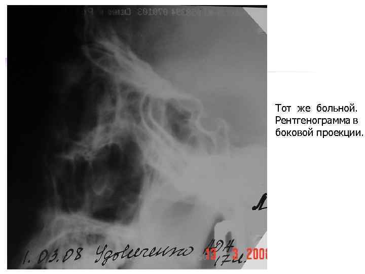 Тот же больной. Рентгенограмма в боковой проекции. 