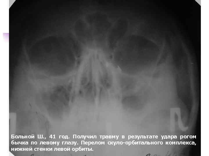 Больной Ш. , 41 год. Получил травму в результате удара рогом бычка по левому