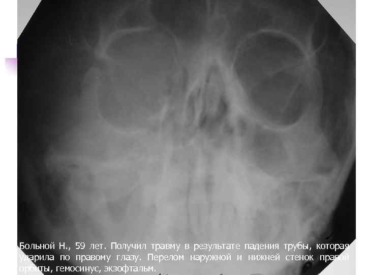 Больной Н. , 59 лет. Получил травму в результате падения трубы, которая ударила по