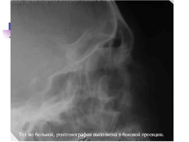 Тот же больной, рентгенография выполнена в боковой проекции. 