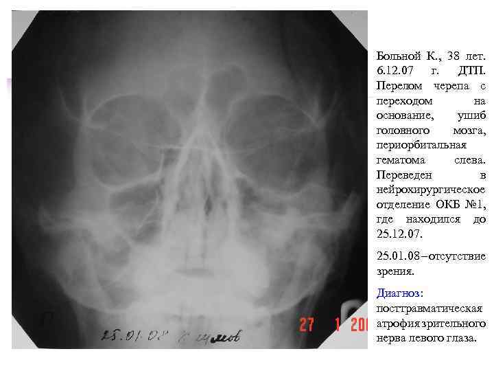 Больной К. , 38 лет. 6. 12. 07 г. ДТП. Перелом черепа с переходом