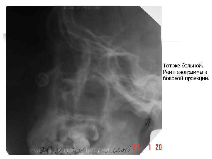Тот же больной. Рентгенограмма в боковой проекции. 