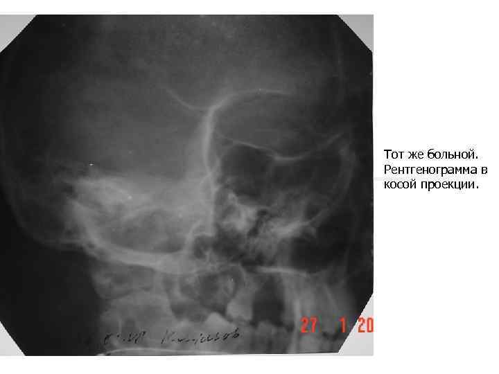 Тот же больной. Рентгенограмма в косой проекции. 