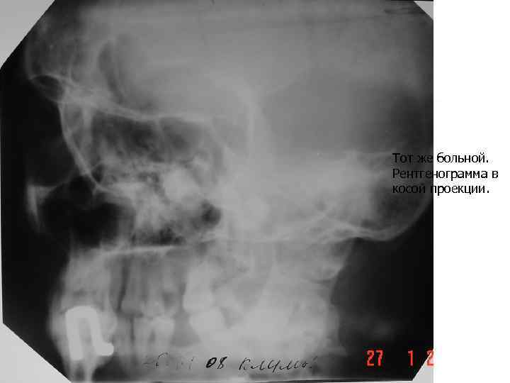 Тот же больной. Рентгенограмма в косой проекции. 