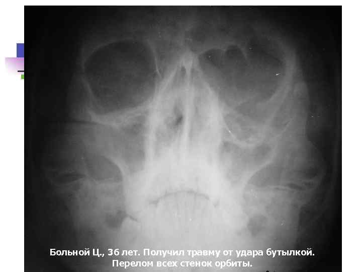 Больной Ц. , 36 лет. Получил травму от удара бутылкой. Перелом всех стенок орбиты.