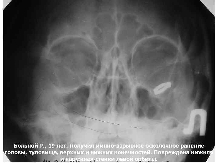 Больной Р. , 19 лет. Получил минно-взрывное осколочное ранение головы, туловища, верхних и нижних